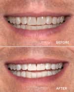 Image 3 of 5: Supersmile Superstrips Teeth Whitening Strips, 14 Pack
