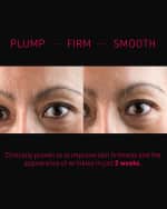 Image 2 of 4: Foreo FAQ Microneedling Anti-Wrinkle Hyaluronic Acid Patches For Forehead