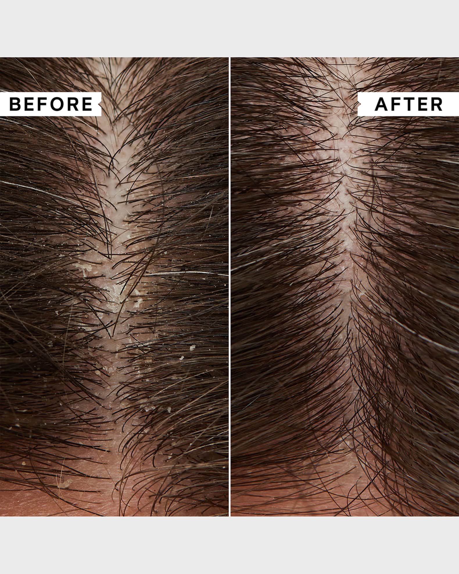 8.5 oz. Flaky Scalp Cleansing Shampoo 1